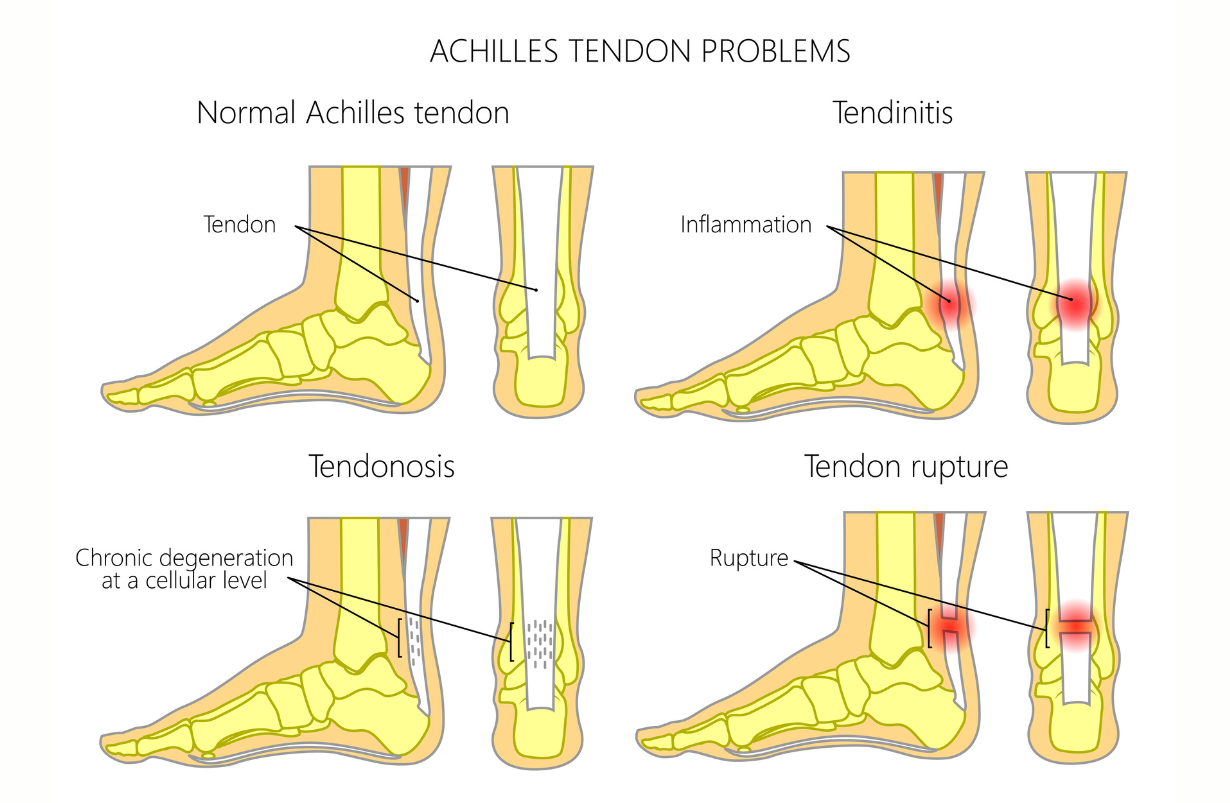 Achilles Tendinitis