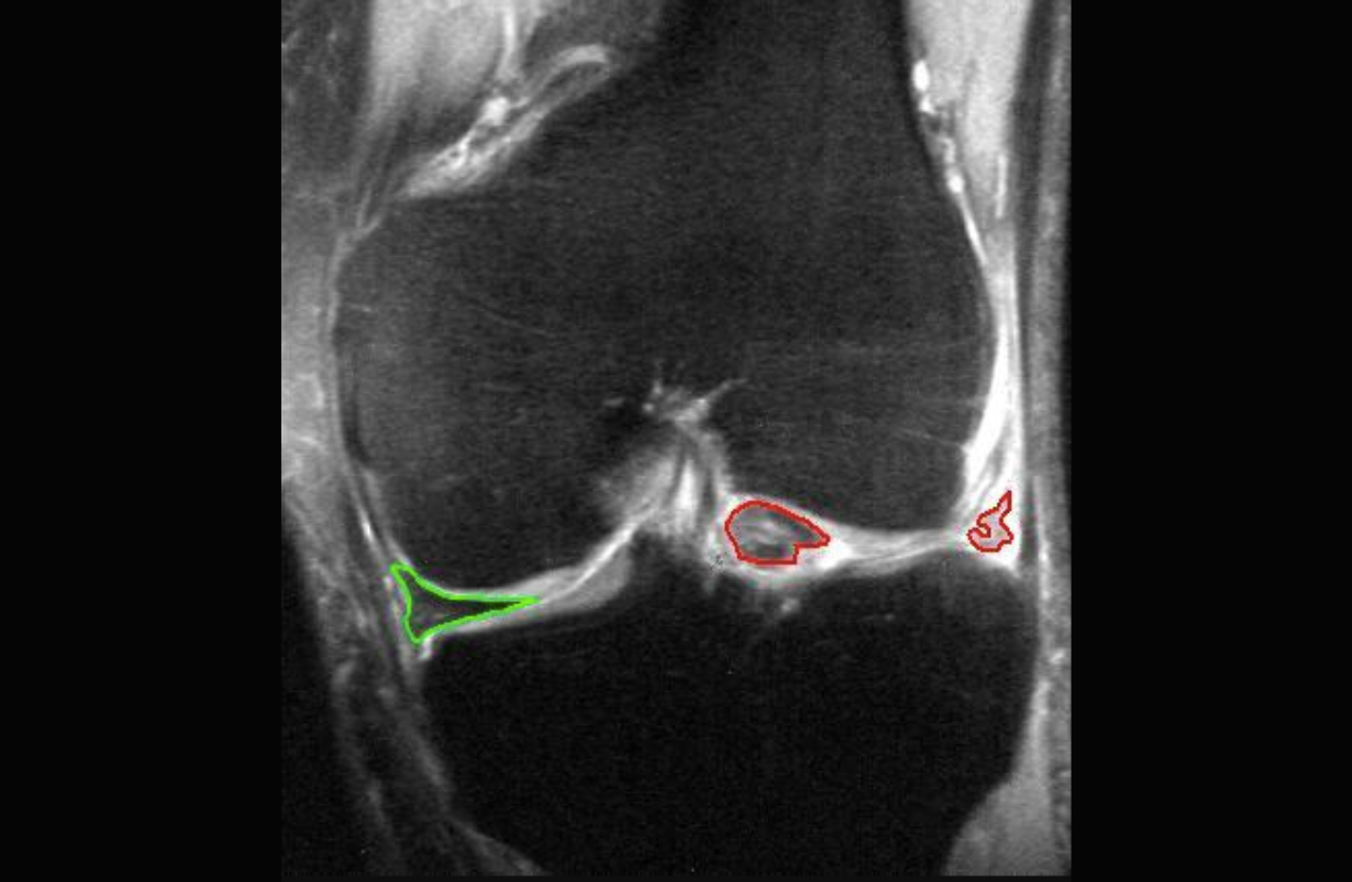 Lateral Meniscal Tear