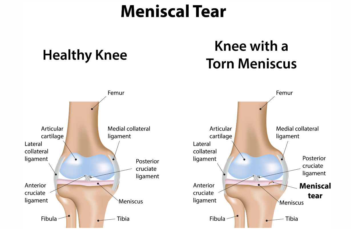 Medial Meniscal Tear