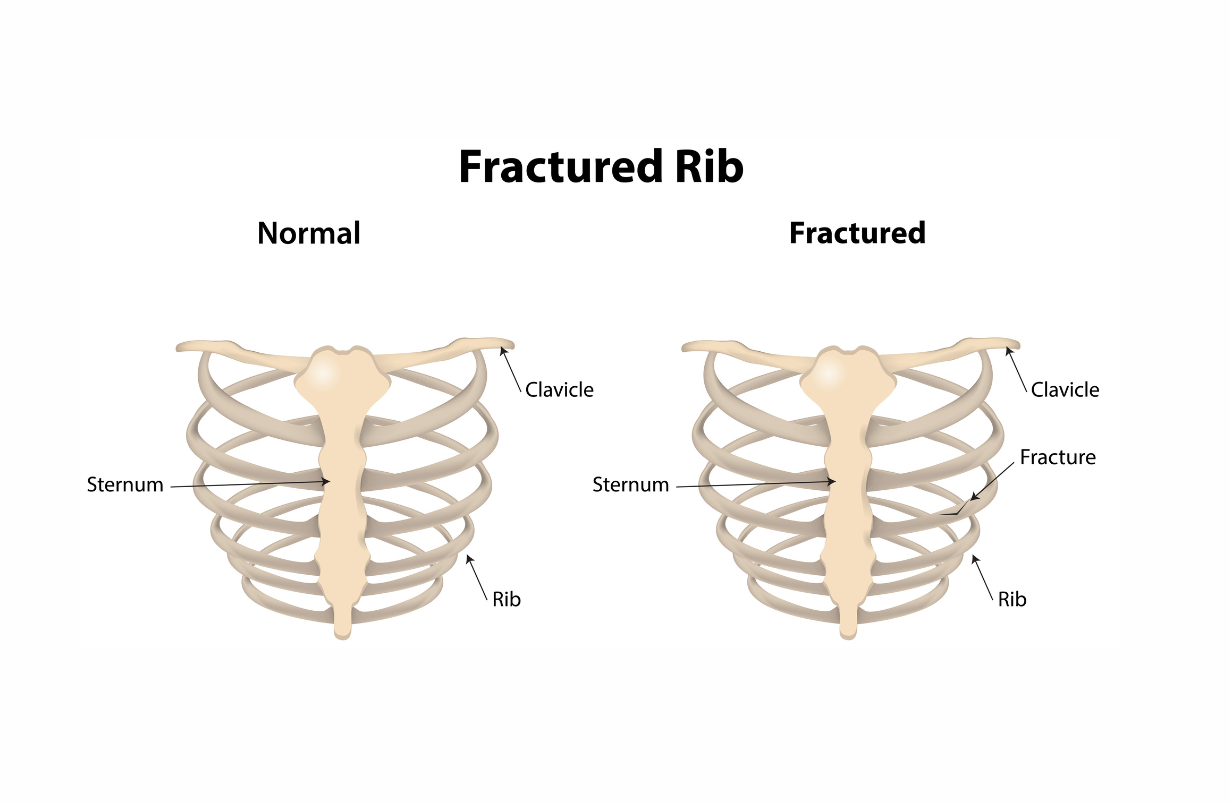 Rib Fracture