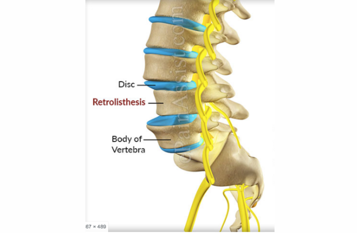 Retrolisthesis