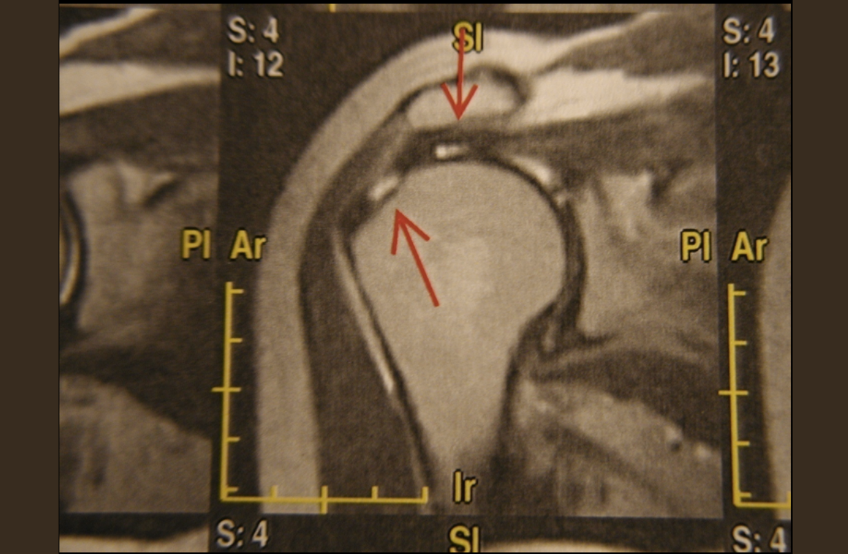 Rotator Cuff Syndrome