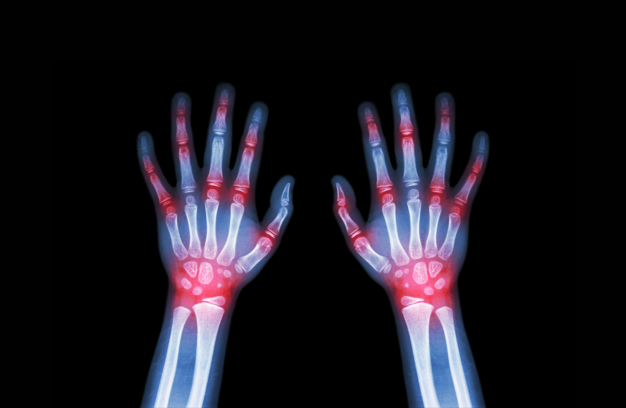 Rheumatoid Arthritis
