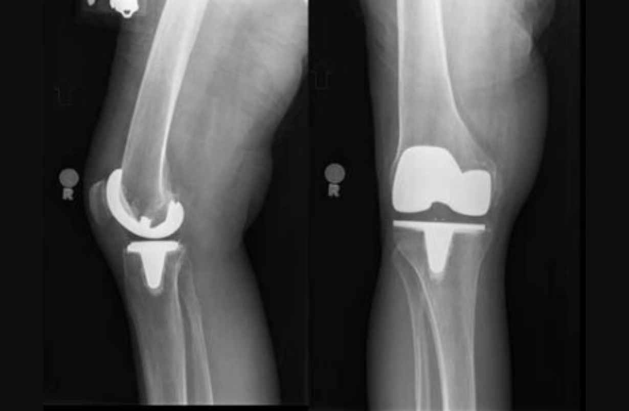 Total Knee Replacement