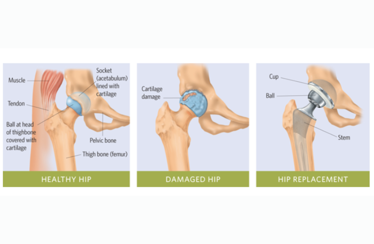 Anterior Total Hip Replacement