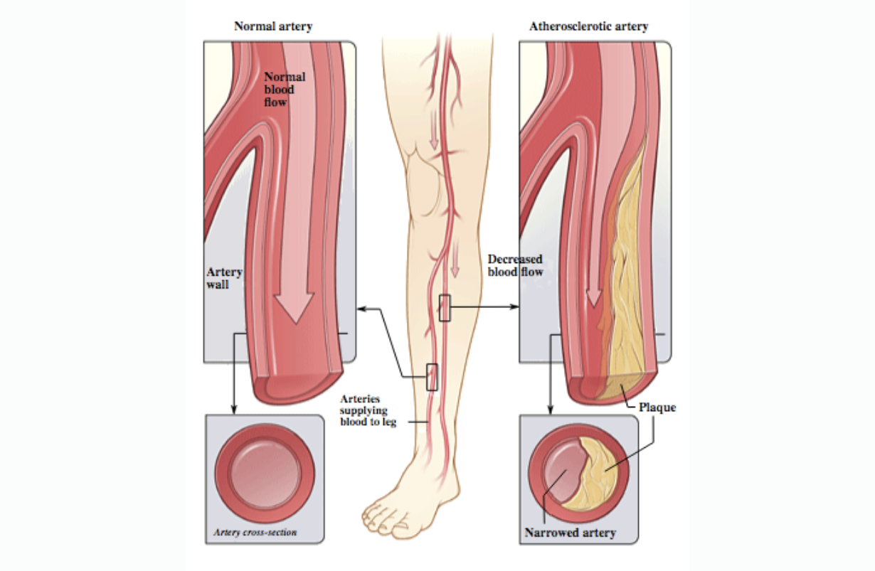 Arterial Peripheral Vascular Disease
