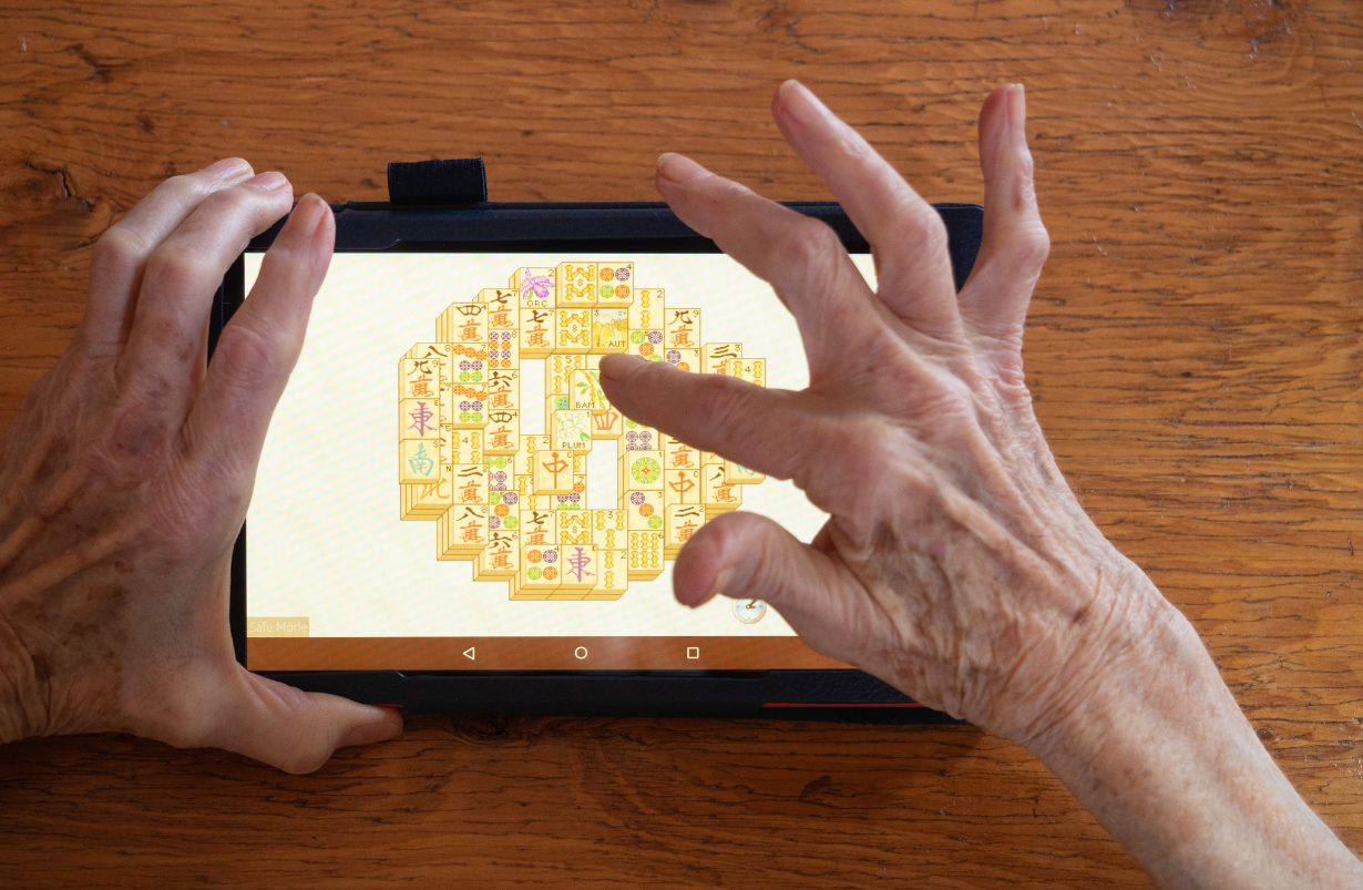 Arthritis of basal joint of thumb