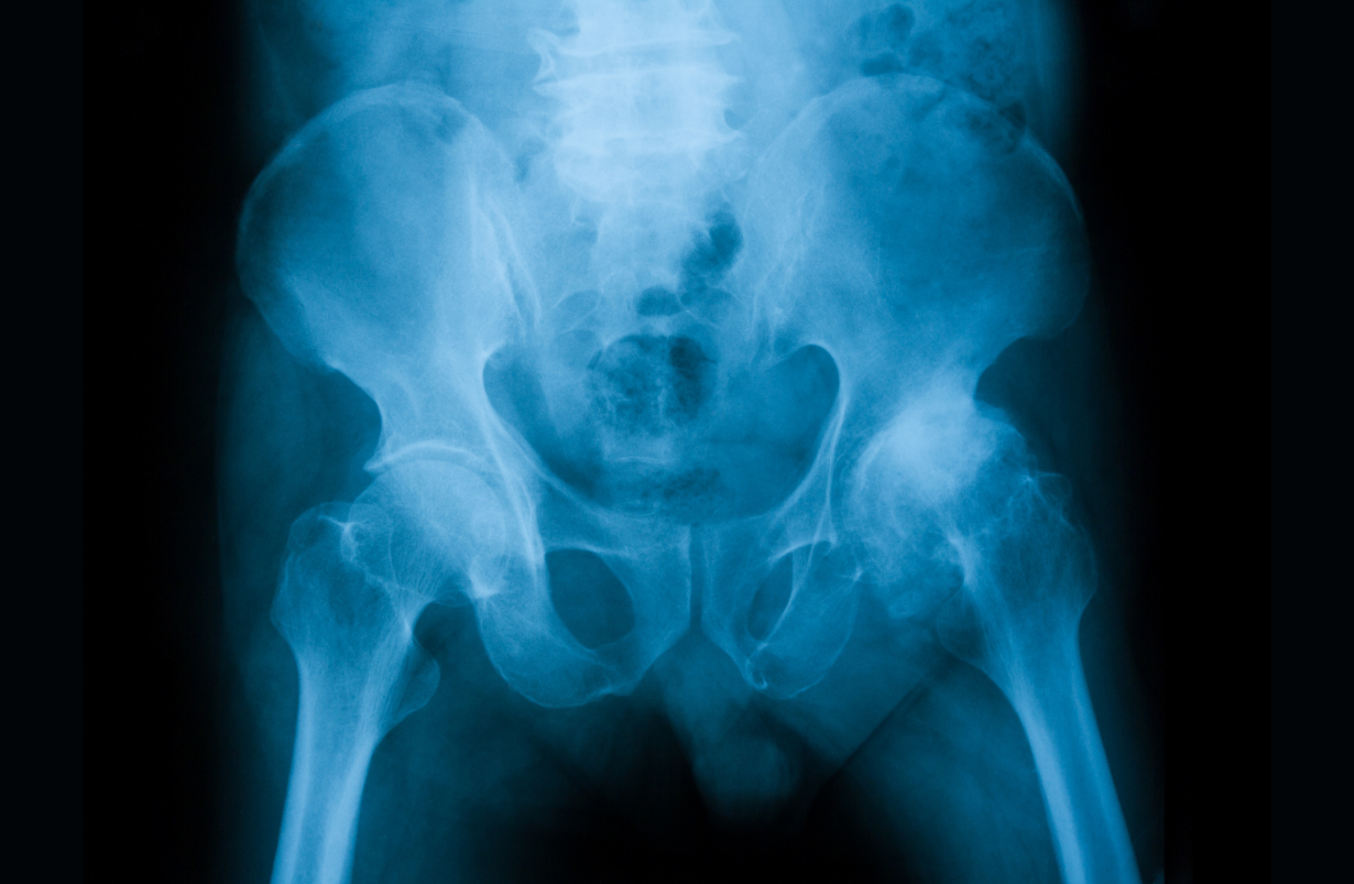 Arthritis Hip
