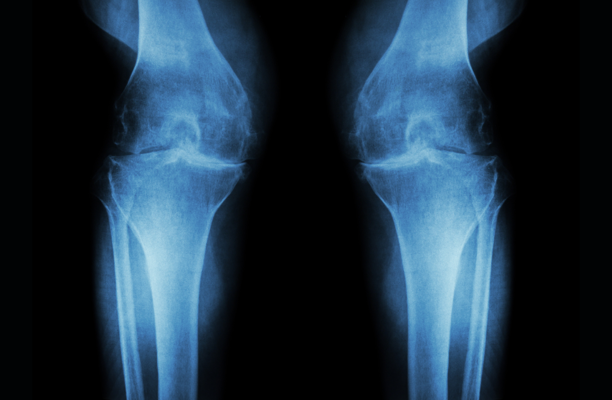 Arthritis Knee