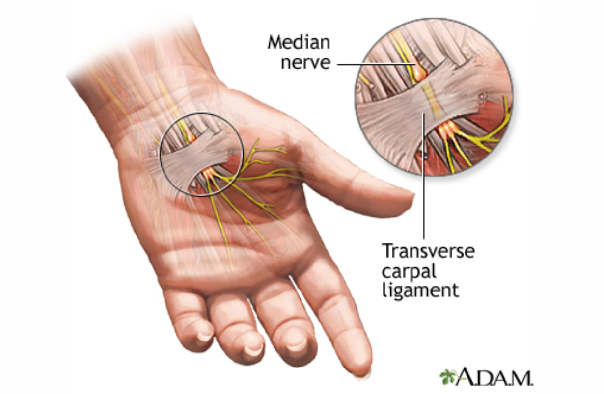 Carpal Tunnel Syndrome