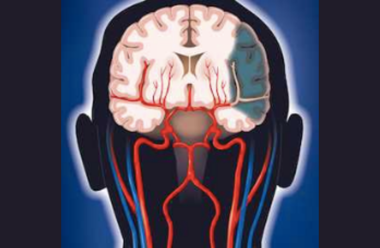 Cerebrovascular Accident