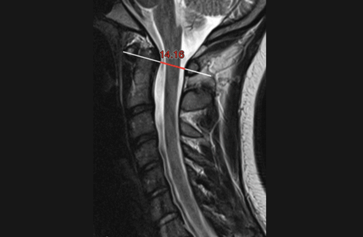 Cervical Spinal Stenosis