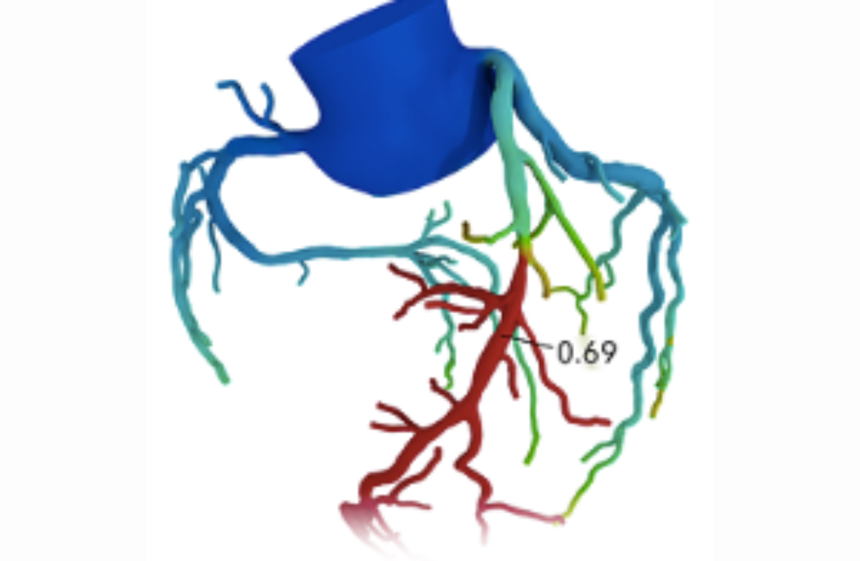 Coronary Arterial Disease
