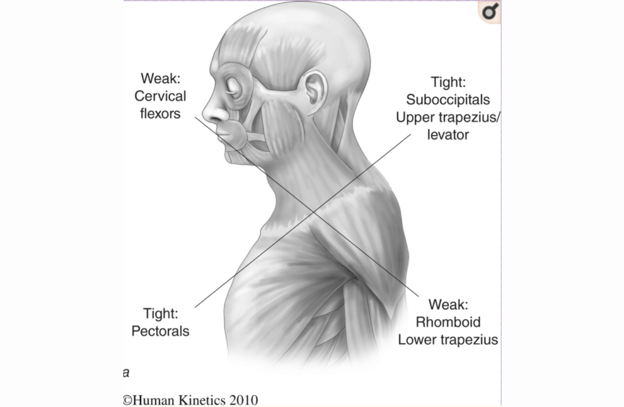 Headache Cervicogenic Cephalgia