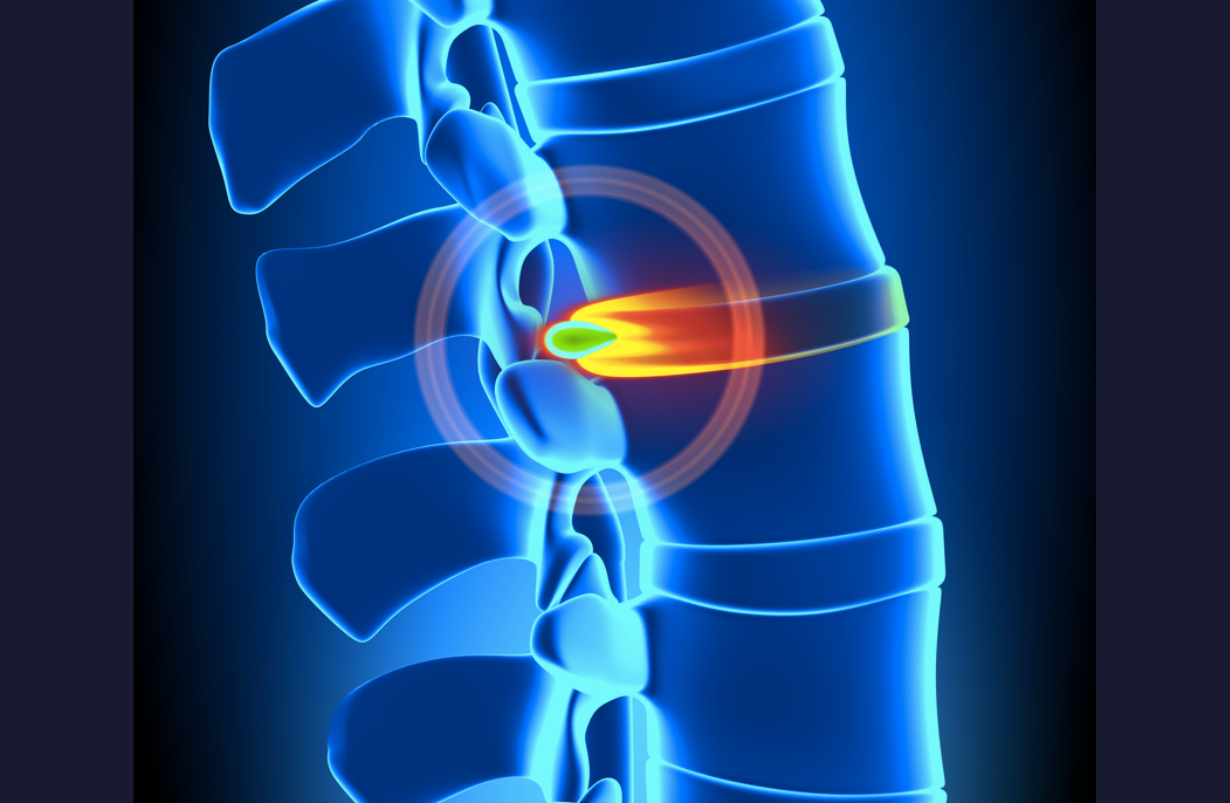 Herniated Thoracic Disc
