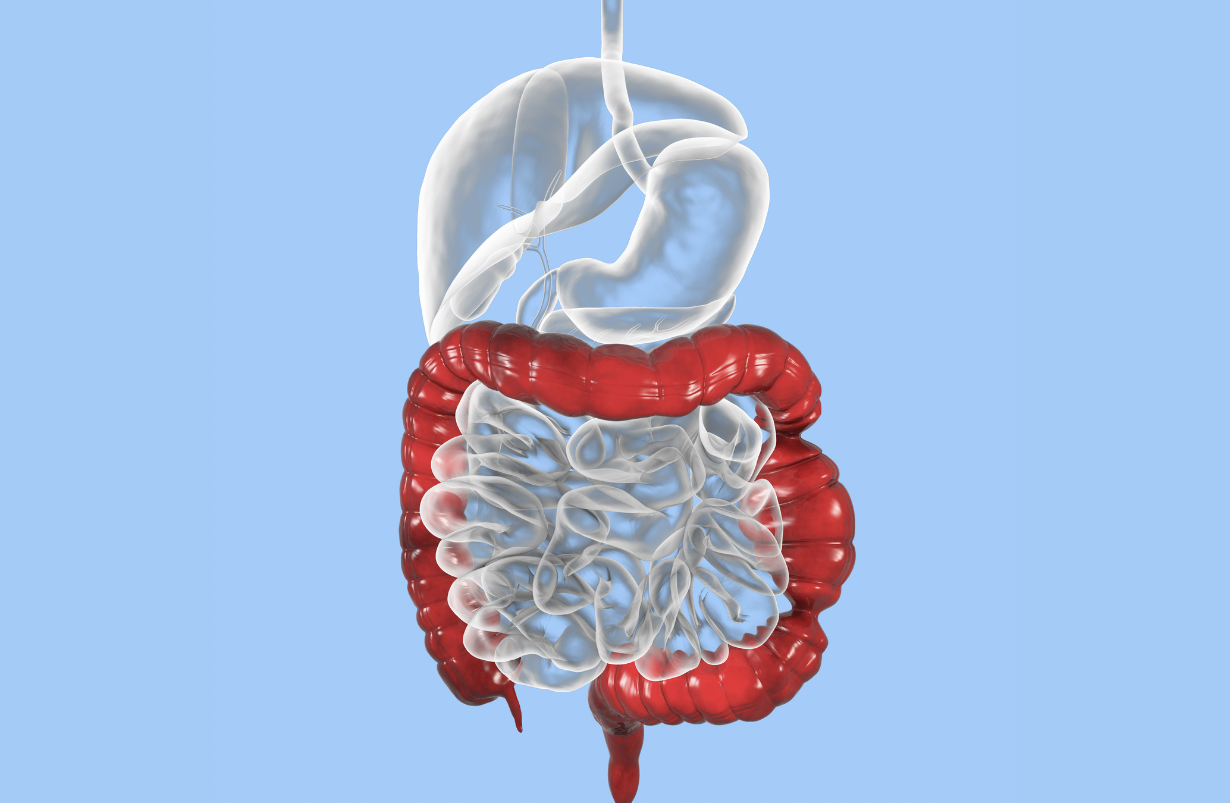 Irritable Bowel Syndrome