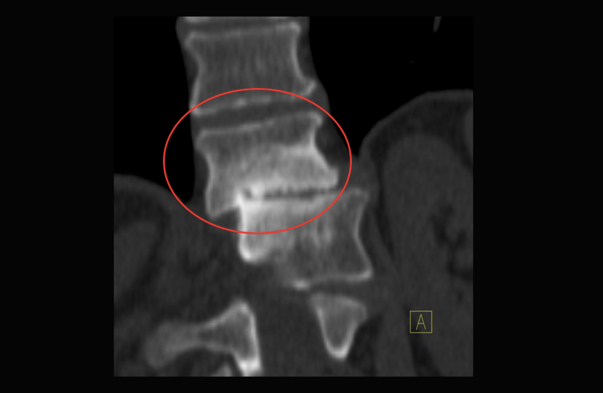 Lateral Listhesis