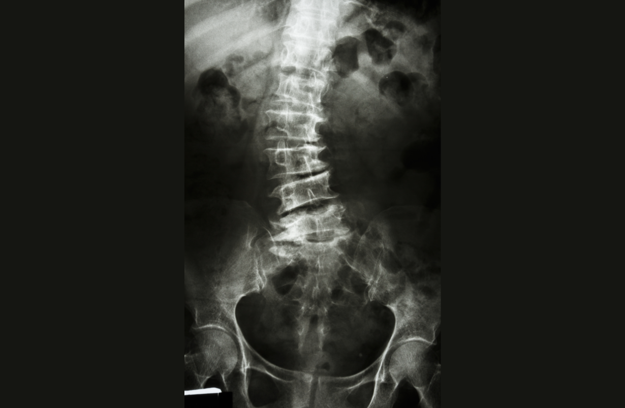 Scoliosis
