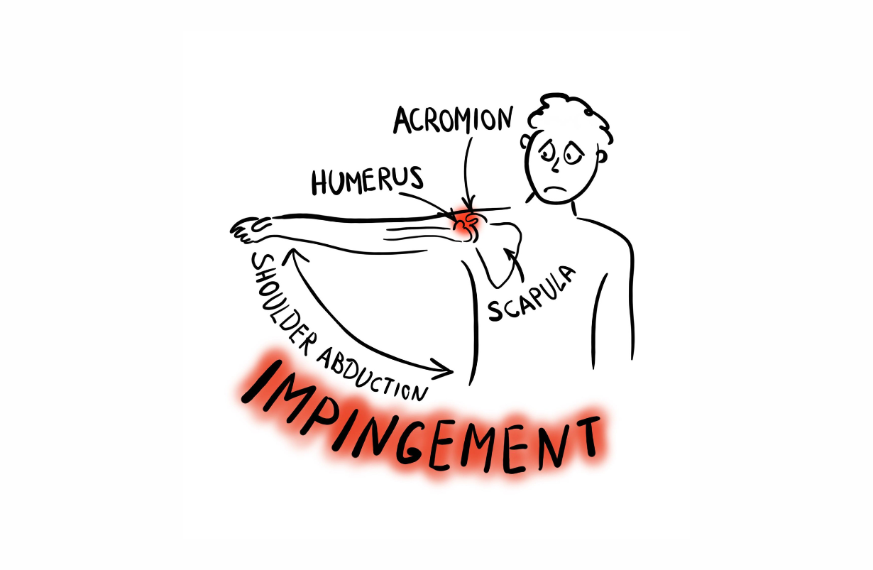 Shoulder Impingement