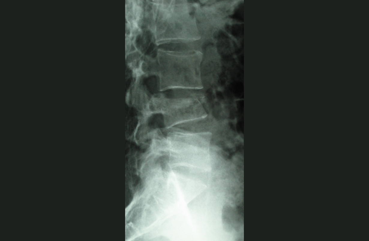 Spinal Fracture (vertebral body), Compression Fracture