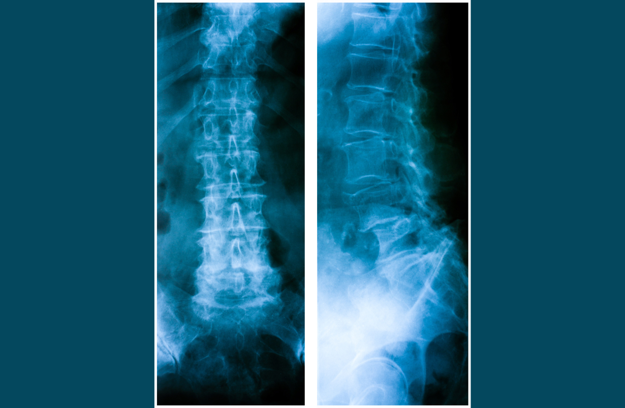 Spondylolisthesis