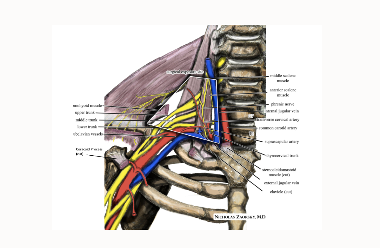 Thoracic Outlet Syndrome
